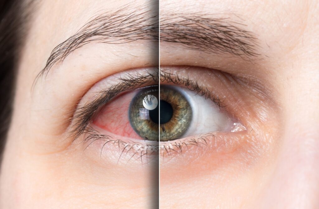Dry, red eye before and after IPL (intense pulsed light)treatment