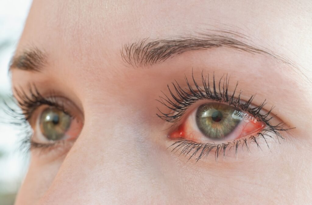 Close-up of red and irritated eyes caused by severe dry eye.