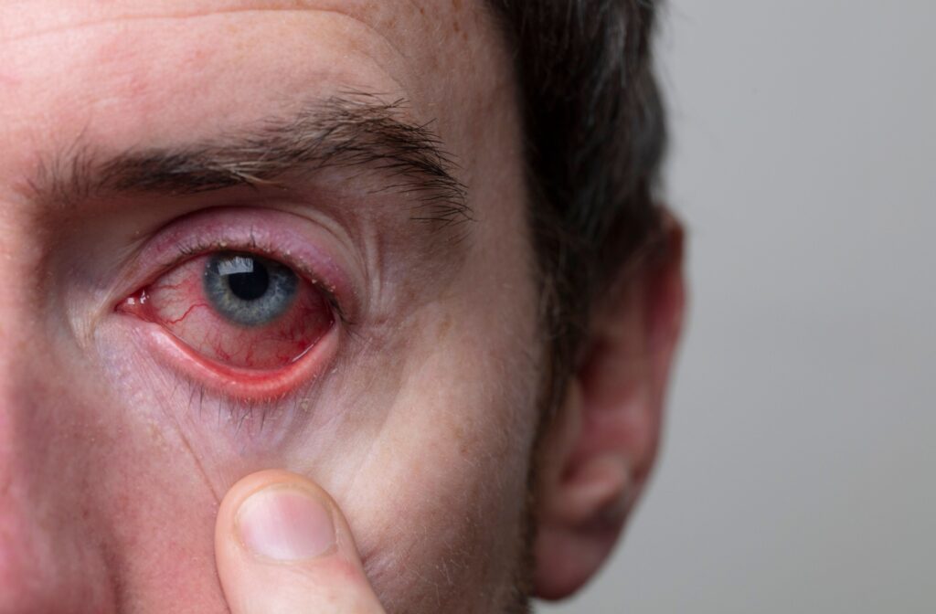 A close-up showing a person experiencing the onset of blepharitis, as marked by their red eyes and the flaky skin along the eyelids.