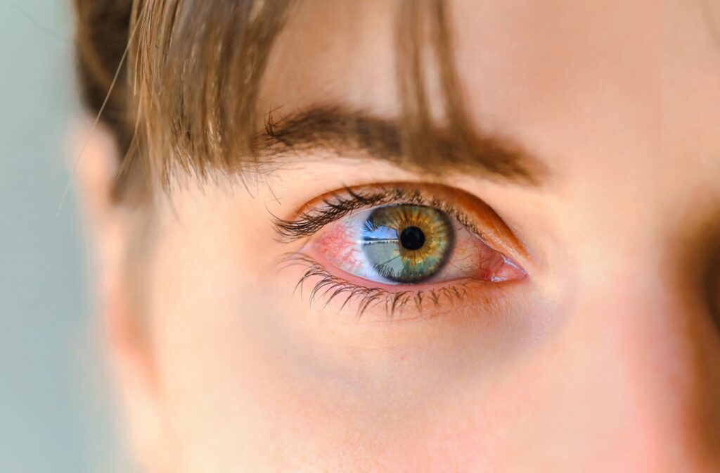 Close-up image of a red, dry eye showing signs of irritation and light sensitivity.
