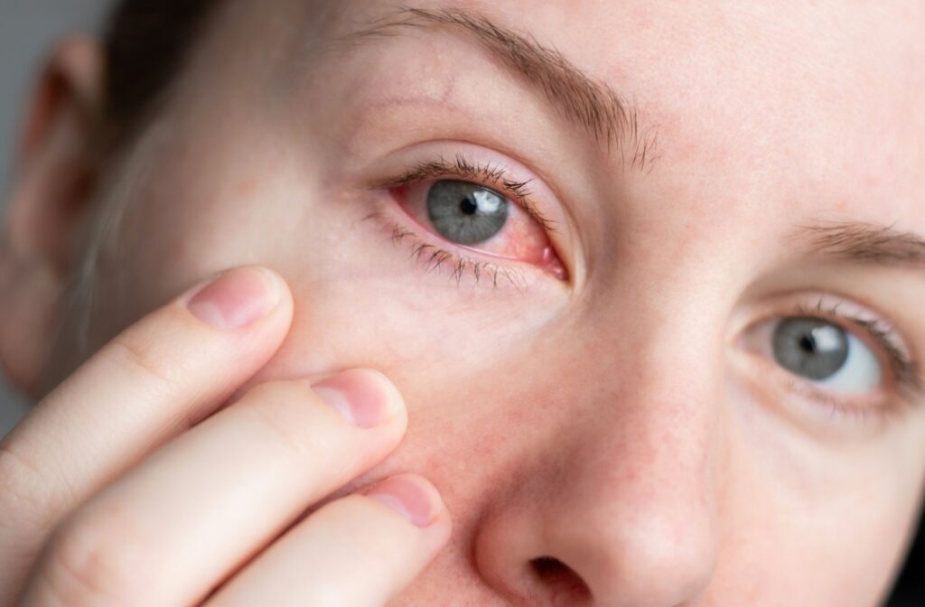 Close up of a person pulling their under eye skin down to show they red dry eyes