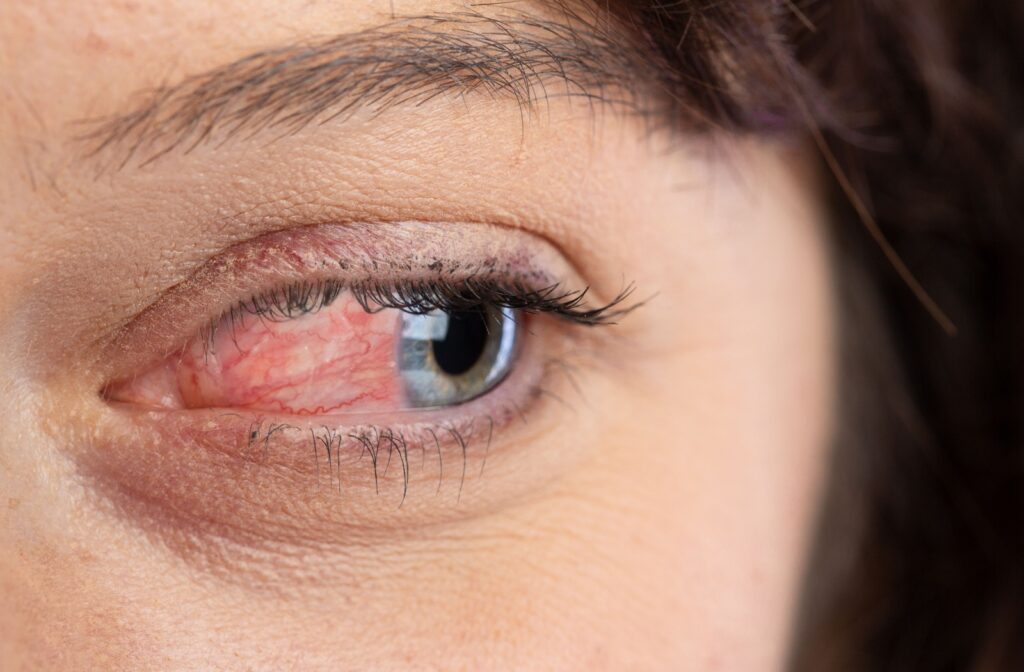 A close up of a red and irritated eye